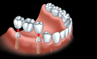 A custom-made bridge is anchored to the dental implants.