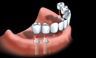 Implant bridges can be used when all your teeth are missing.