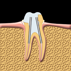 The tooth is prepared for a crown. Posts are used to help support the crown