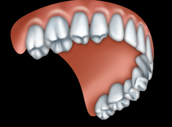 A full upper denture