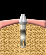 An abutment is attached to the implant. The abutment connects the artificial tooth to the implant.