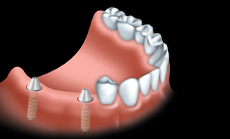 A fixed bridge is anchored to dental implants to replace one or more teeth.