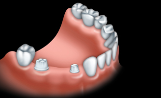 With a traditional bridge, healthy teeth on each side of the missing tooth are prepared for crowns.