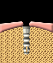 A dental implant is inserted into the jawbone.